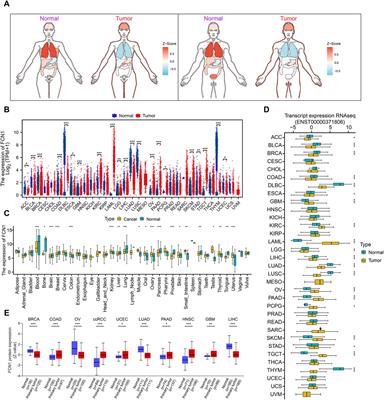 Multi-omics evaluation of the prognostic value and immune signature of FCN1 in pan-cancer and its relationship with proliferation and apoptosis in acute myeloid leukemia